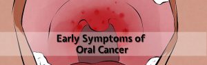Early Symptoms of Oral Cancer